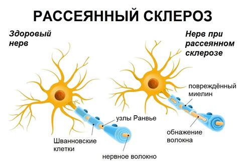 рассеянный склероз передается по наследству|Наследственность при рассеянном склерозе